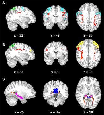 Developmental Topographical <mark class="highlighted">Disorientation</mark> With Concurrent Face Recognition Deficit: A Case Report